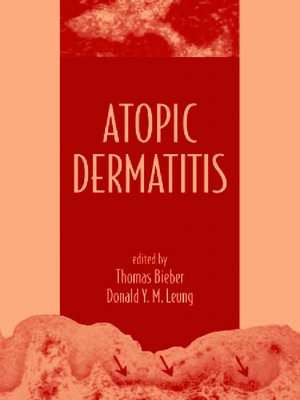 cover image of Atopic Dermatitis